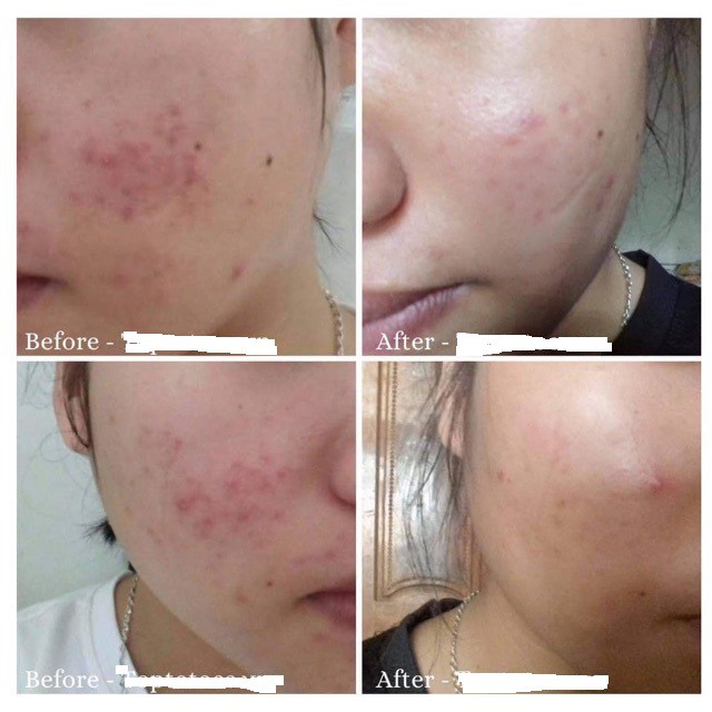 Serum giảm mụn, giảm viêm cấp tốc TEANA ANTI-REDNESS SUPER PEPTIDES