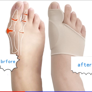 2 Cặp 1 Cặp Dụng Cụ Chỉnh Hình Ngón Chân Cái