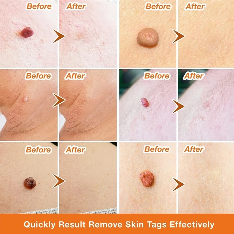 Serum Hỗ Trợ Giảm Mụn Cóc Nốt Ruồi Không Đau Hiệu Quả