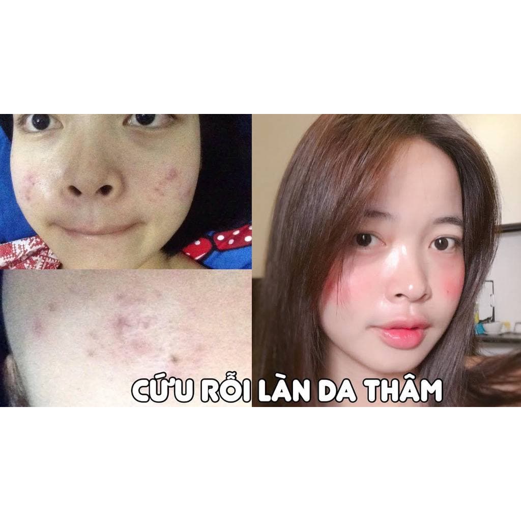 Kem giảm thâm mụn, làm mờ vết thâm, cải thiện sắc tố da Zuzu Cosmetic