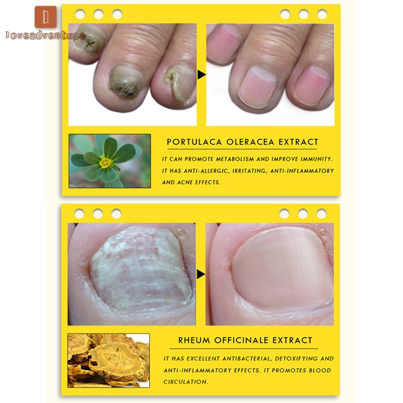 LV△ Ginseng Antibacterial Nail Treatments Essential Oil Nails Fungus Repair Foot Nail Care