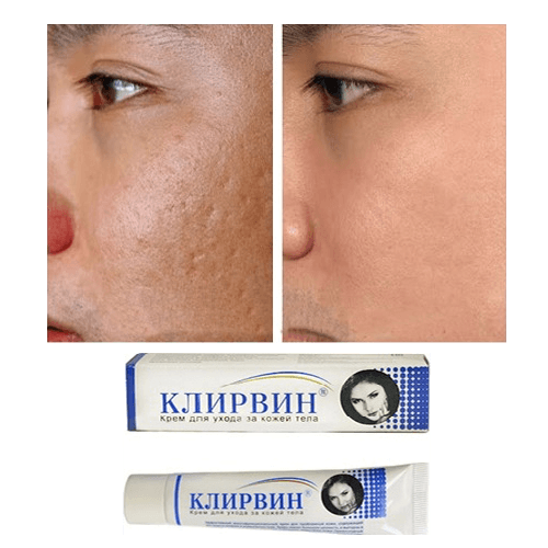 Kem làm hết sẹo Nga, mờ vết thâm do mụn, sau sinh, rạn da, sẹo lồi, lõm, vết nứt, sẹo rỗ, sẹo bỏng vô cùng hiệu quả