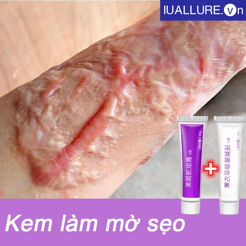 Kem xóa sẹo kem liền sẹo khôi phục da sẹo Giảm sẹo60g làm mềm phần da bị khô sừng làm mờ sẹo khôi phục gấp đôi có thể dùng cho sẹo mụn, vết rạn sau sinh, vết thương bị bỏng, sẹo mổ sau sinh Kem làm mờ sẹoKem xóa sẹo kem khuyết điểm vết rạn da loại bỏ hắc
