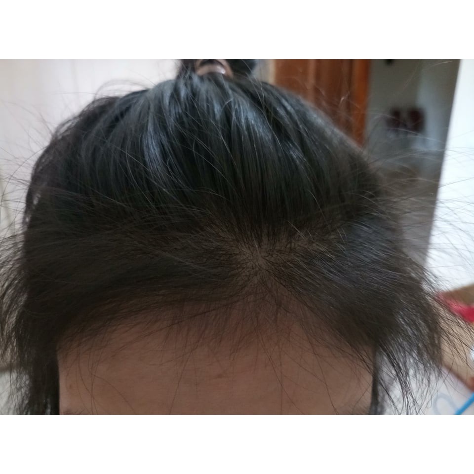 COMBO 2 SIÊU MỌC TÓC NATULIFE | BigBuy360 - bigbuy360.vn