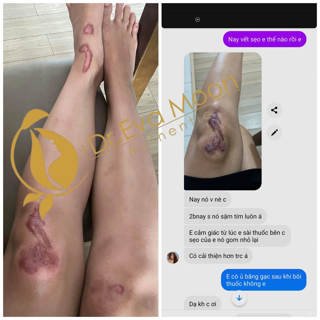 Kem sẹo collagen handmade