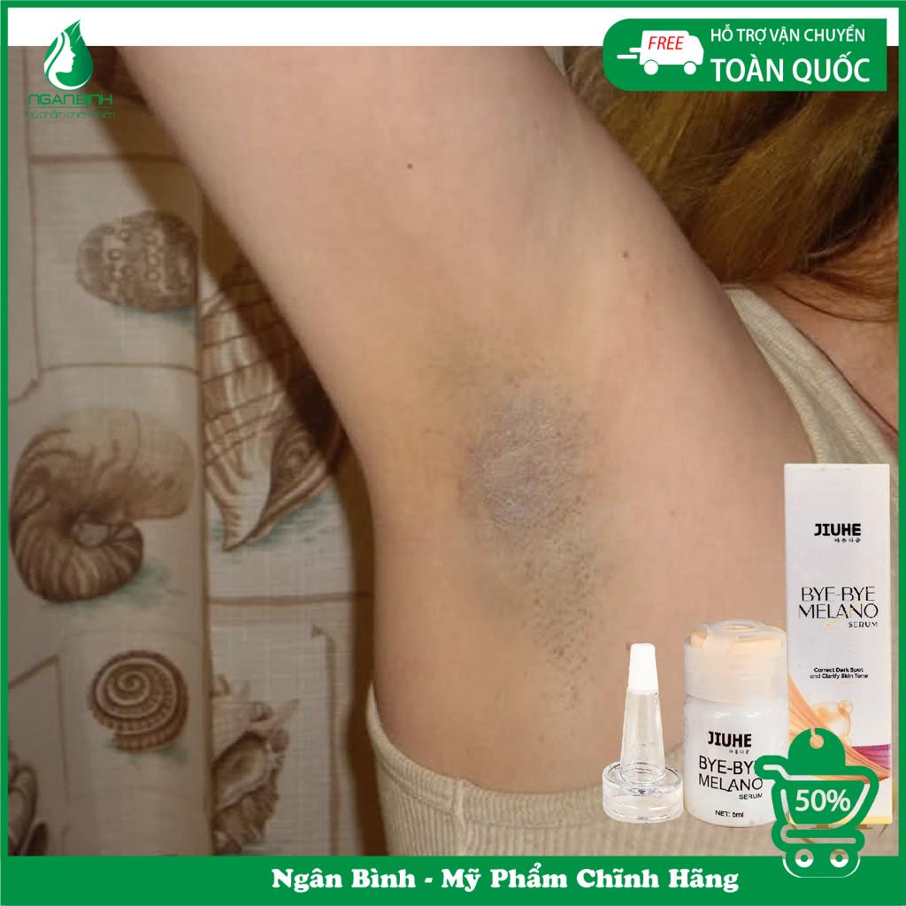 Serum thâm jiuhe, thâm mụn cho da dầu,tinh chất  thâm nám ,thâm môi,thâm mắt,thâm vùng kín,