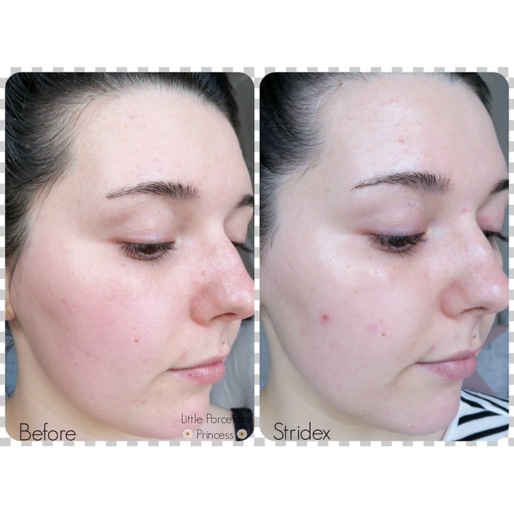 BÔNG TẨM MỤN STRIDEX MAXIMUM STRENGTH 90 MIẾNG CHÍNH HÃNG - 5361