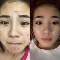 Serum Loại Bỏ Mụn Detox Blanc