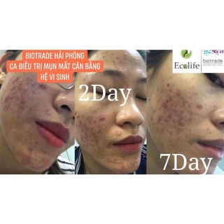 Kem Chấm Mụn - Active Cream 30ml