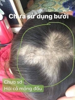 COMBO 3 CHAI TINH DẦU BƯỞI KÍCH MỌC TÓC ( tặng quà hấp dẫn )