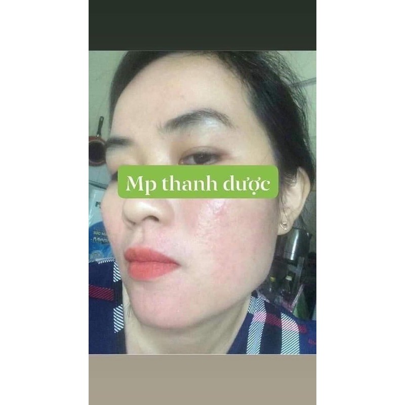 [SIZE 40ML] SERUM THANH DƯỢC - LÁRE THẢO DƯỢC ĐIỀU TRỊ DA | BigBuy360 - bigbuy360.vn