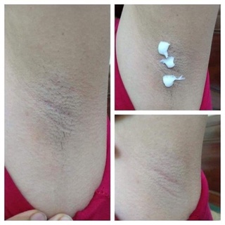 TRIỆT LÔNG NANO Gel