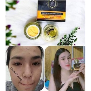 Kem face mụn Huỳnh Đỗ