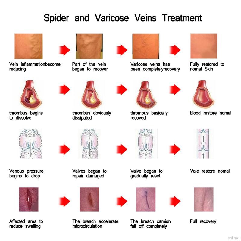 [Hàng mới về] Tuýp thuốc mỡ trong suốt dành cho người bị giãn tĩnh mạch vận động viên