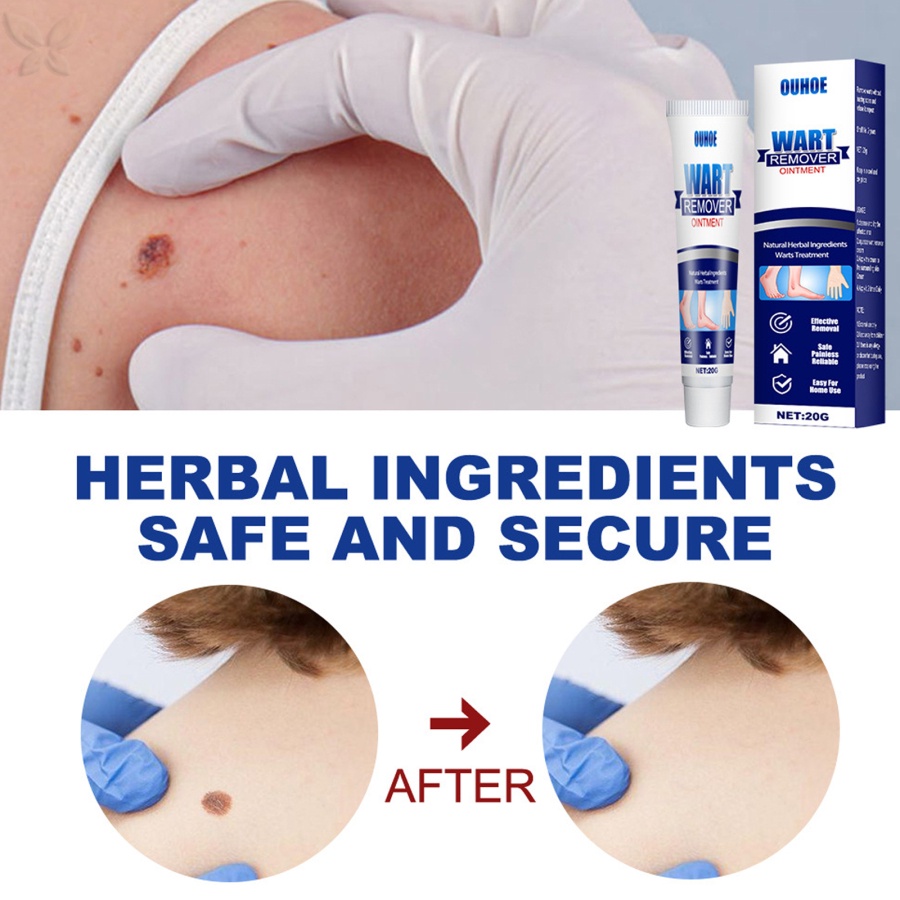 Tuýp Kem Hỗ Trợ Giảm Mụn Cóc Và Đốm Nâu Tự Nhiên 20g JMMZ