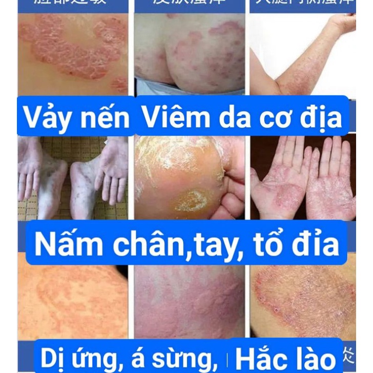 Kem bôi ngoài da,bôi nấm ngứa,vảy nến, á sừng, tổ đỉa, nấm tay, nấm chân, hiệu quả