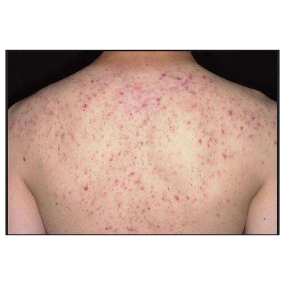 Xà phòng Amore giảm mụn lưng, mụn mông, nang lông 70g - AB Authentic | BigBuy360 - bigbuy360.vn