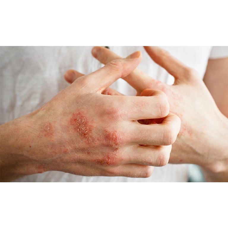 Thảo dược Bôi Hết Sạch Ghẻ nước, Ngứa, Rát, Bong tróc, Lột da, Nứt lẻ từng vùng từng mảng LUÔN SẴN CÓ