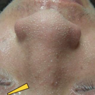 Ủ mụn+ serum se khít