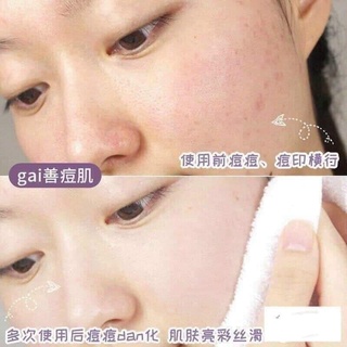 [GIẢM 99 CHO ĐƠN TỐI THIỂU 200K] Lăn mụn đầu đen