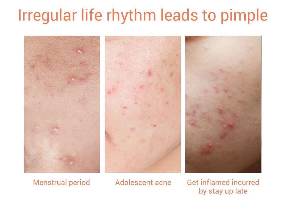 Bộ 25 miếng dán hỗ trợ giảm mụn che khuyết điểm trong suốt LANBENA | BigBuy360 - bigbuy360.vn