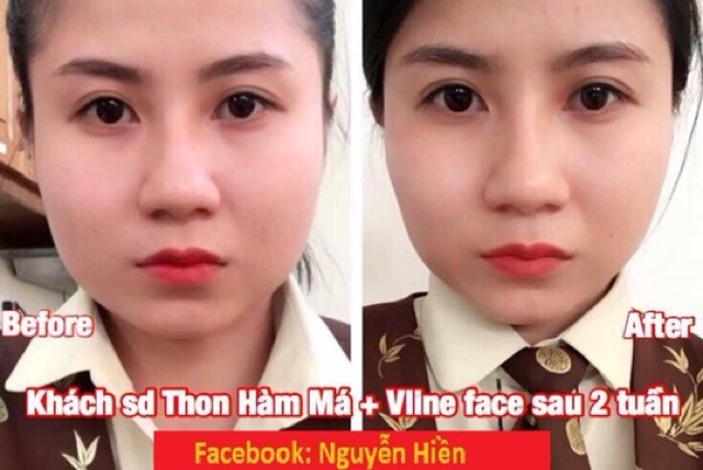 Tinh Chất Thu xương Vline Face Hàn