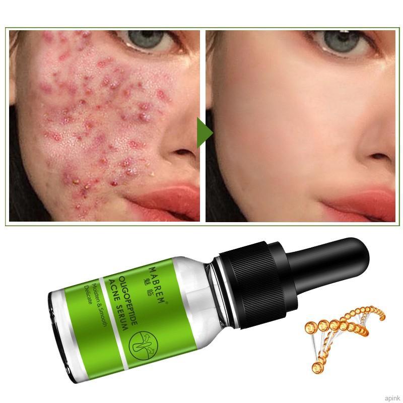 [Hàng mới về] Tinh Chất Oligopeptide Giảm Mụn Dưỡng Ẩm Làm Mịn Da Hiệu Quả