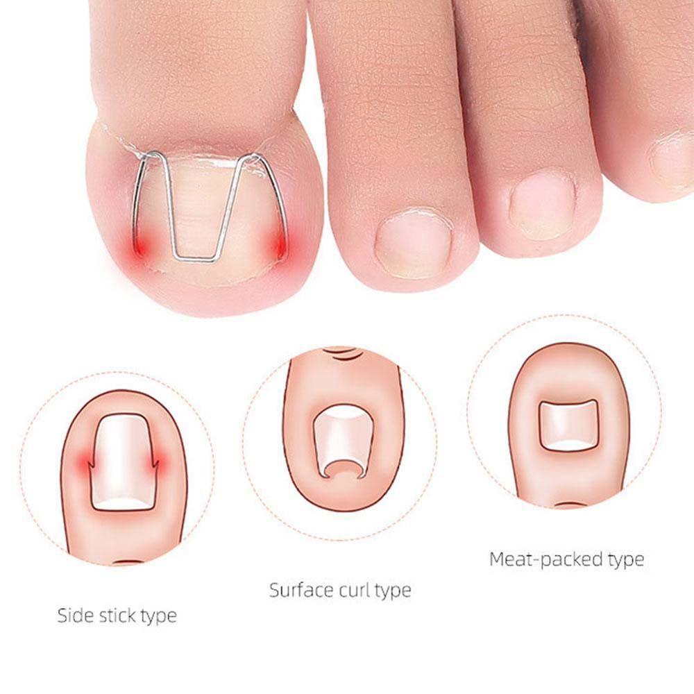 1 Hộp Dụng Cụ Cố Định Móng Chân Bằng Thép Không Gỉ