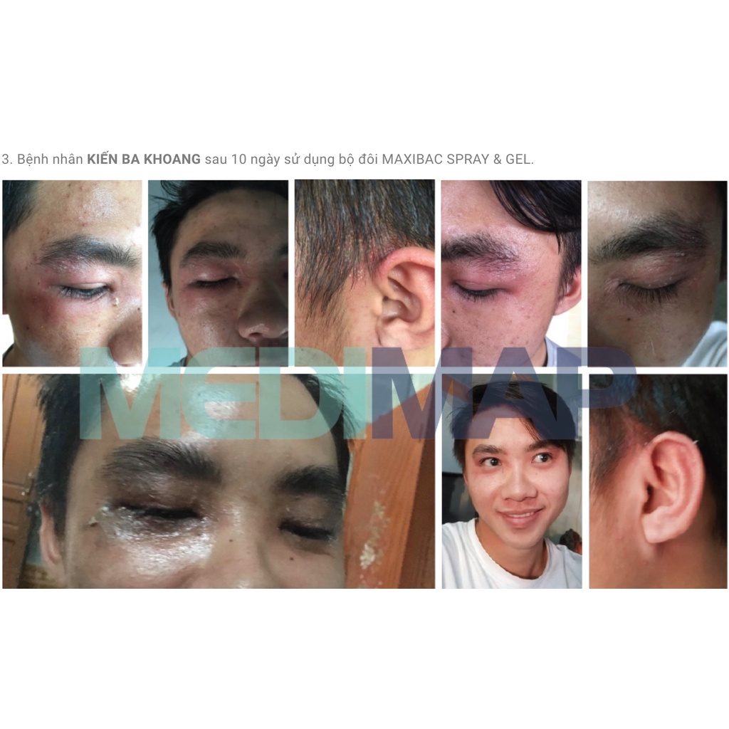 Lỡ Loét Da, Các Dạng Tổn Thương Da, Kháng Khuẩn Da Maxibac Spray & Gel, Nhanh Lành, Không Xót