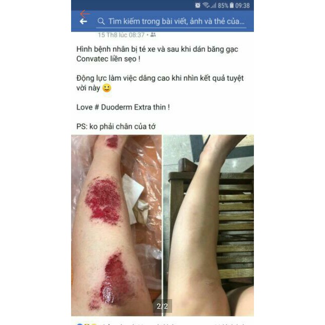 Miếng dán mụn, vết thương, sẹo, phỏng bô...đa năng Duoderm Extrathin 10*10 cm | BigBuy360 - bigbuy360.vn