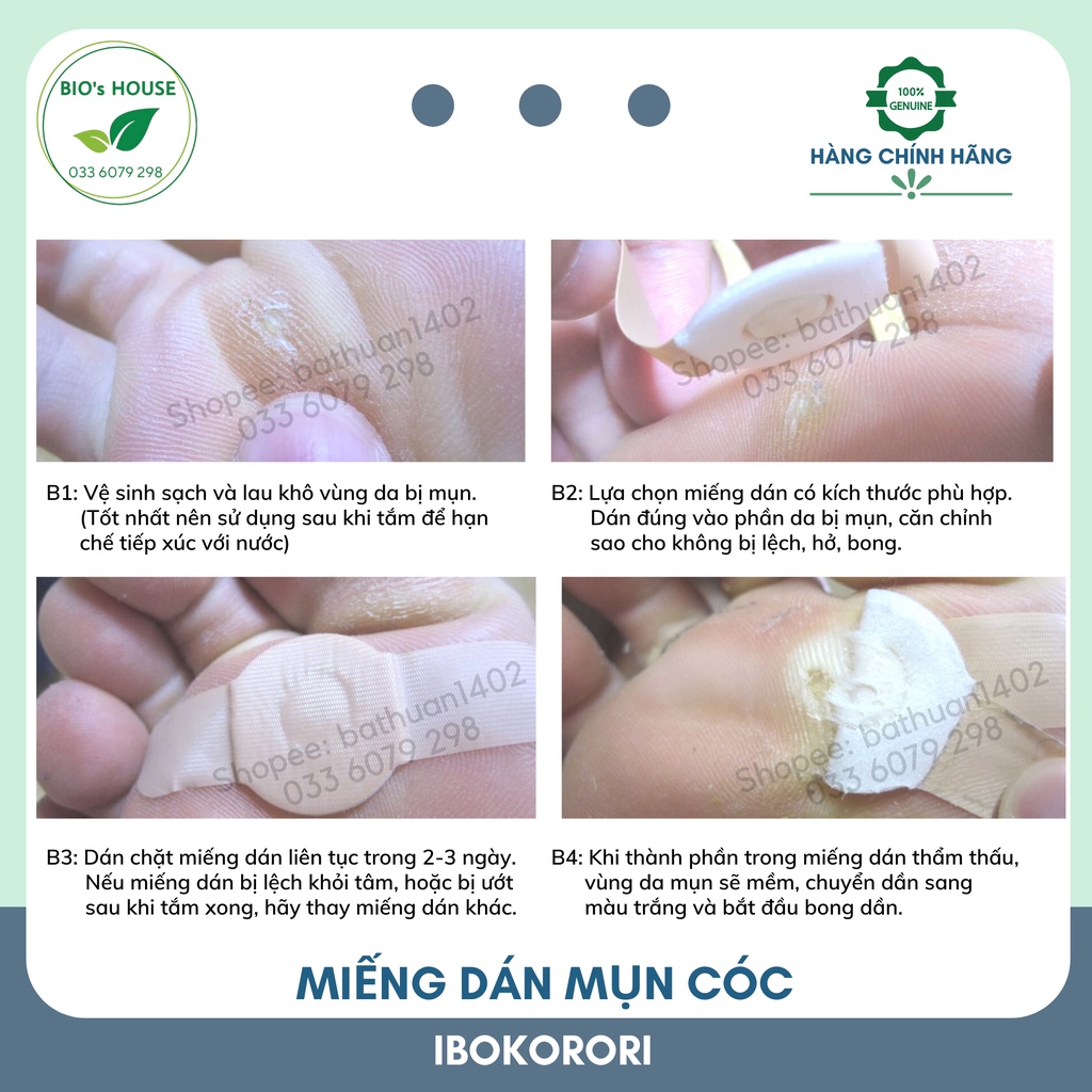 Miếng dán mụn cóc IBOKORORI 12 miếng (Nhật Bản)