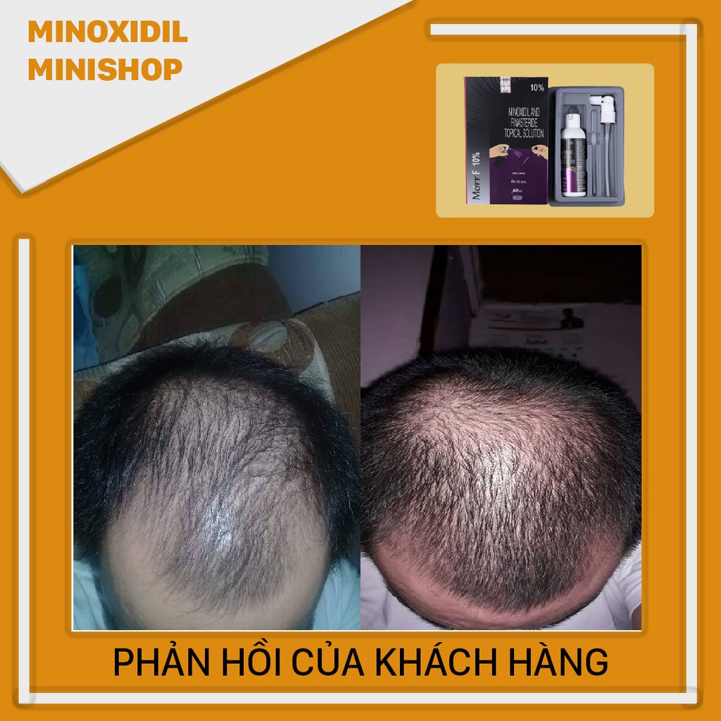 Morr F10% - Thuốc mọc tóc Minoxidil & Finasteride 10% - Morr F10