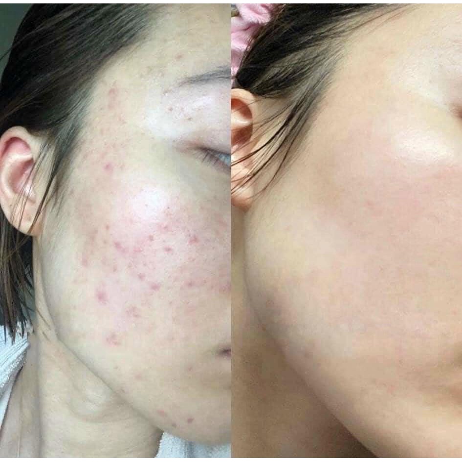 MBC M12 Kem Dưỡng A313 Chống Lão Hóa, Xóa Nhăn, Giảm Thâm Mụn Retinol Cream Pommade 50g Hàng Nội Địa Pháp D2024