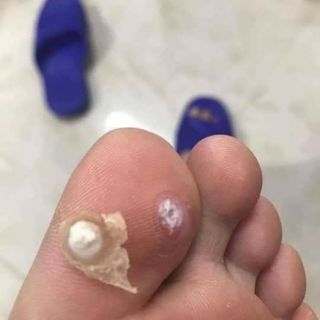 Chấm mụn cốc Cynep của NGA 3ml
