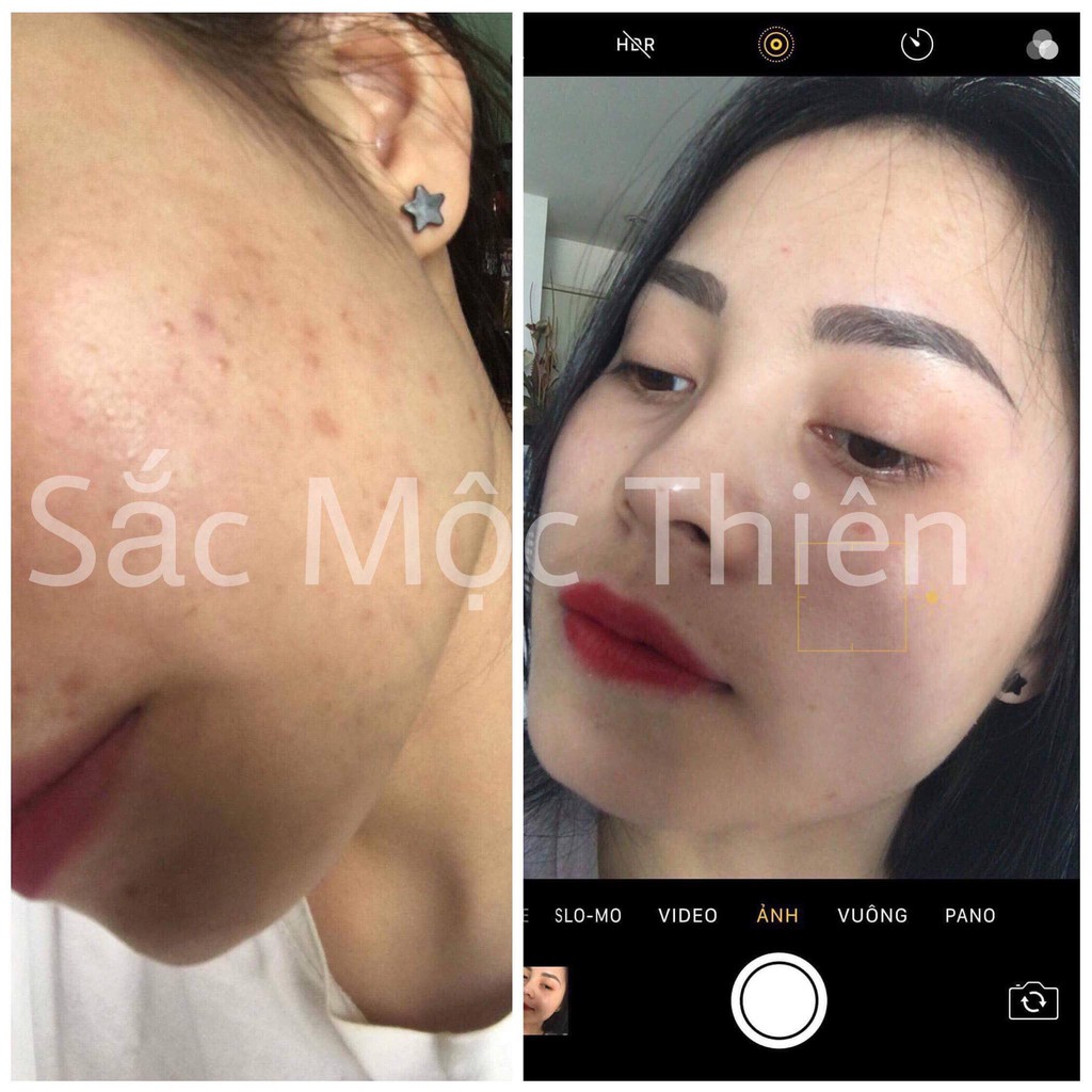 Tái tạo da sắc mộc thiên - Hỗ trợ giảm thâm mụn, nám, sẹo rỗ sau 1 liệu trình sử dụng