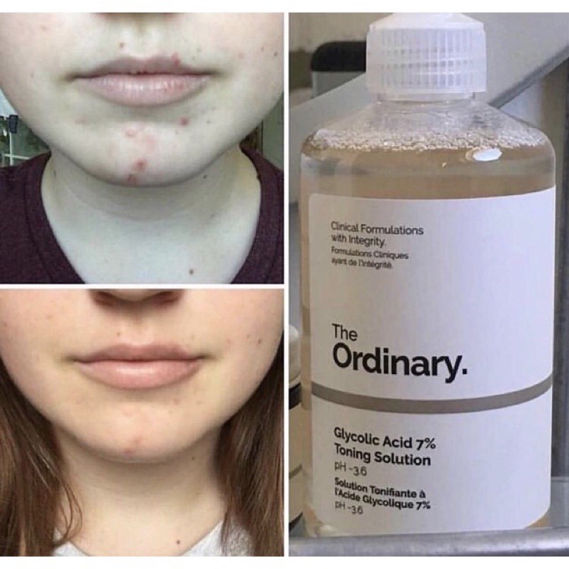 Toner Dưỡng sáng đều màu da The Ordinary Glycolic Acid 7% Toning Solution 240ml