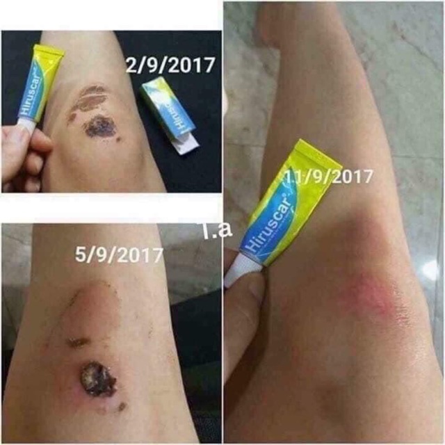 KEM TRỊ SẸO HIRUSCAR THÁI LAN