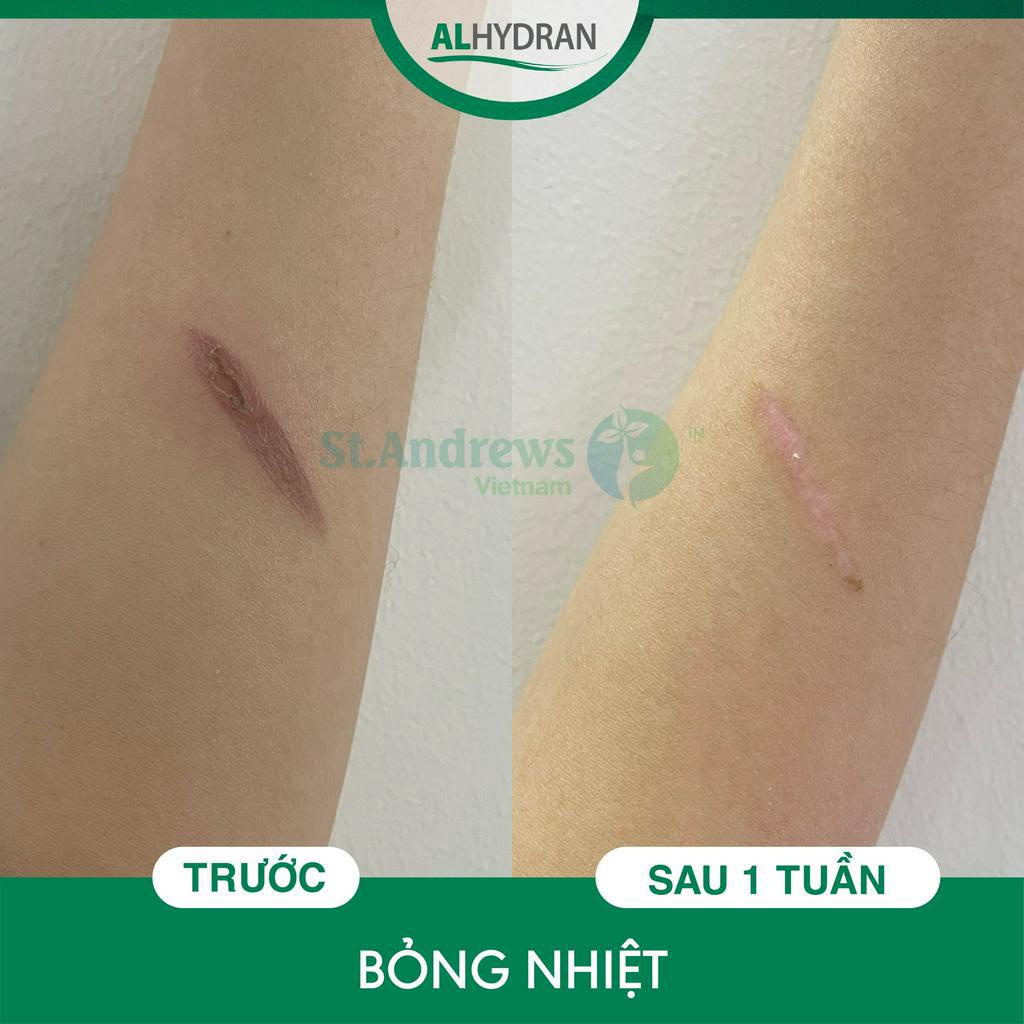 Kem phục hồi da sau lăn kim Alhydran 15ml - hiệu quả đã được kiểm chứng bởi chuyên gia