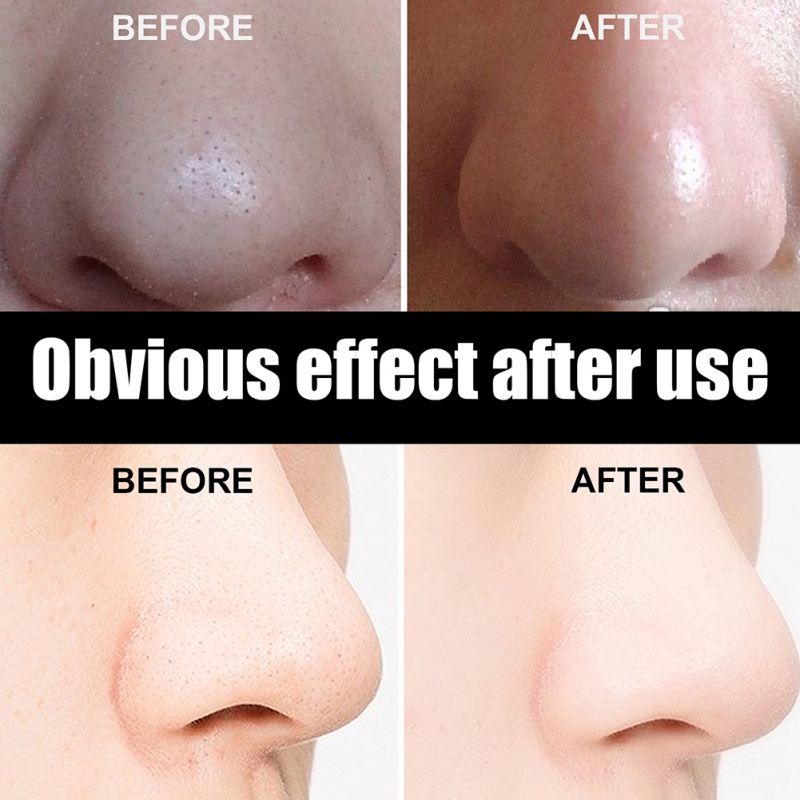 Hộp 10 Miếng Dán Lột Mụn Đầu Đen Vùng Mũi Làm Sạch Lỗ Chân Lông