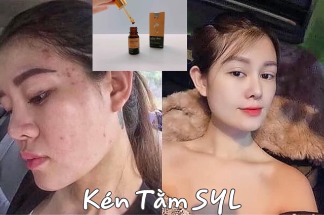 Kén tằm NewSkin tái tạo phục hồi da