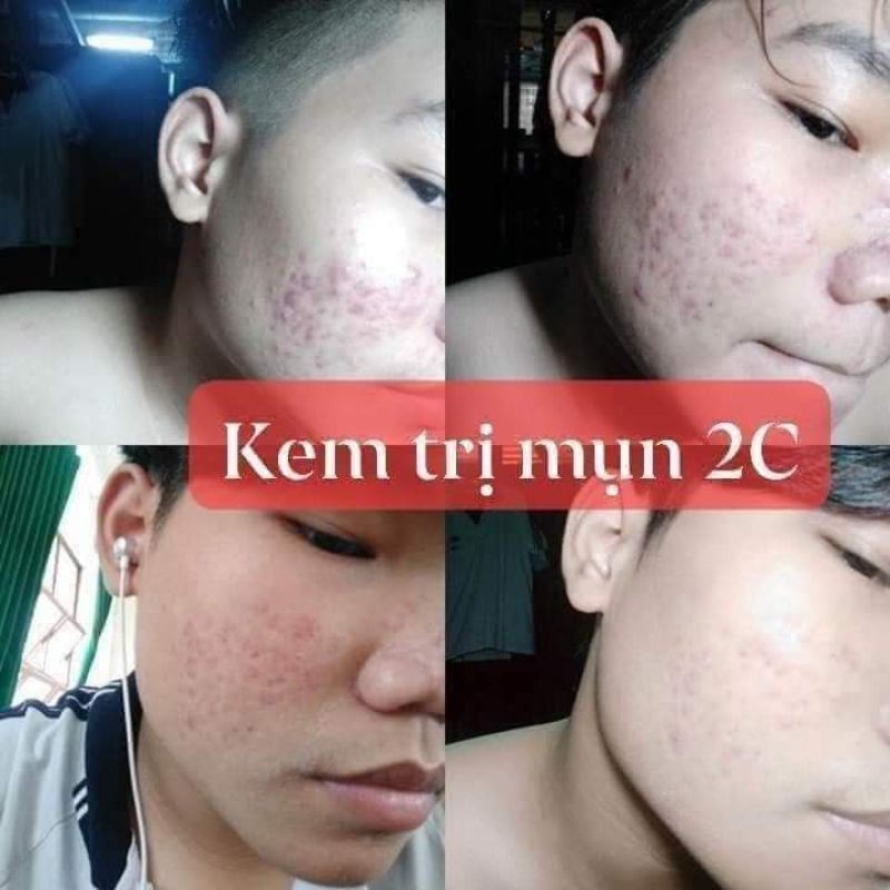 Kem mụn 2C | BigBuy360 - bigbuy360.vn