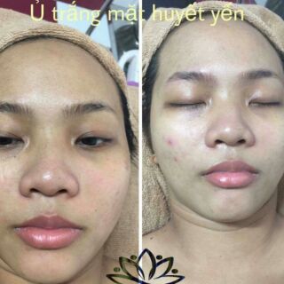 Ủ TRẮNG MẶT HUYẾT YẾN