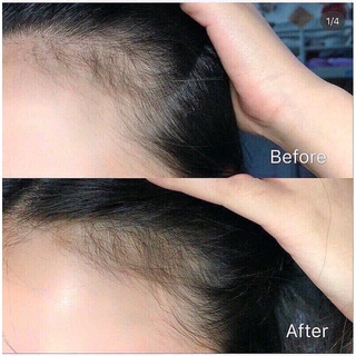 MỌC TÓC BIOTIN MYVITAMINS 90 v / 3 tháng