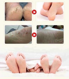 Kem nứt gót chân