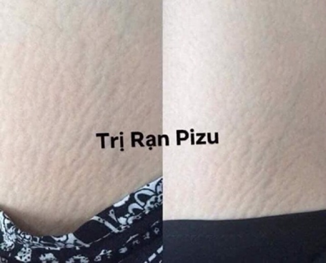 [TINH_DẦU_TRỊ_RẠN_DA_PIZU]