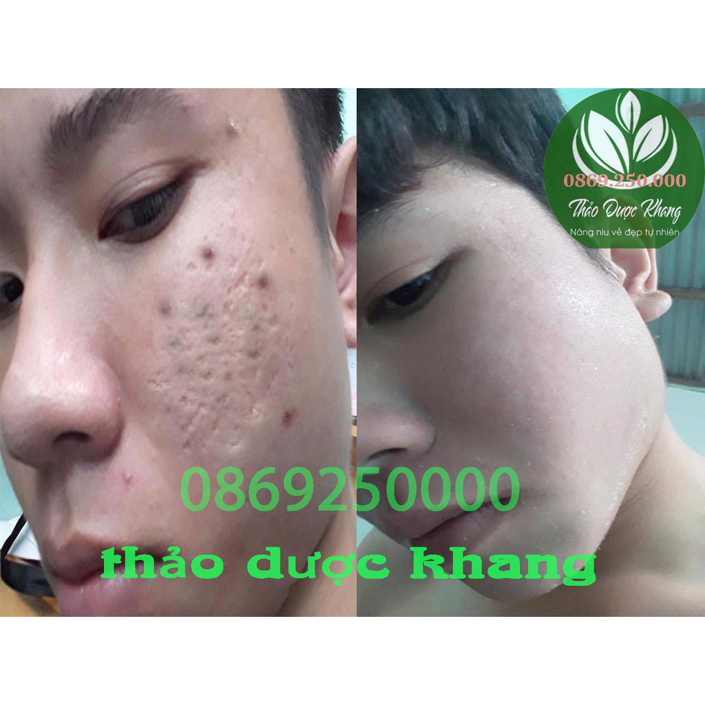 Combo Thảo Dược Khang Serum 30ml Và Bột Thảo Dược