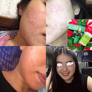 COMBO SERUM THẢO DƯỢC NGỌC LINH SÂM ĐÁNH BAY MỤN ,NÁM ,SẸO RỖ