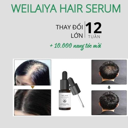 Huyết thanh WEILAIYA, Serum tóc Weilaiya Ginger Hair Root Nourishing Essence (5ml x 8 lọ)