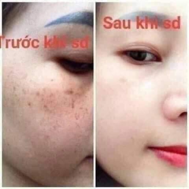 Bộ mờ nám Clobetamil G cao cấp thái lan | BigBuy360 - bigbuy360.vn