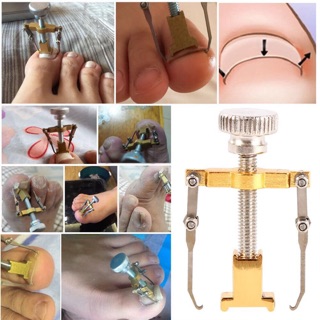 Nâng fom móng quặp